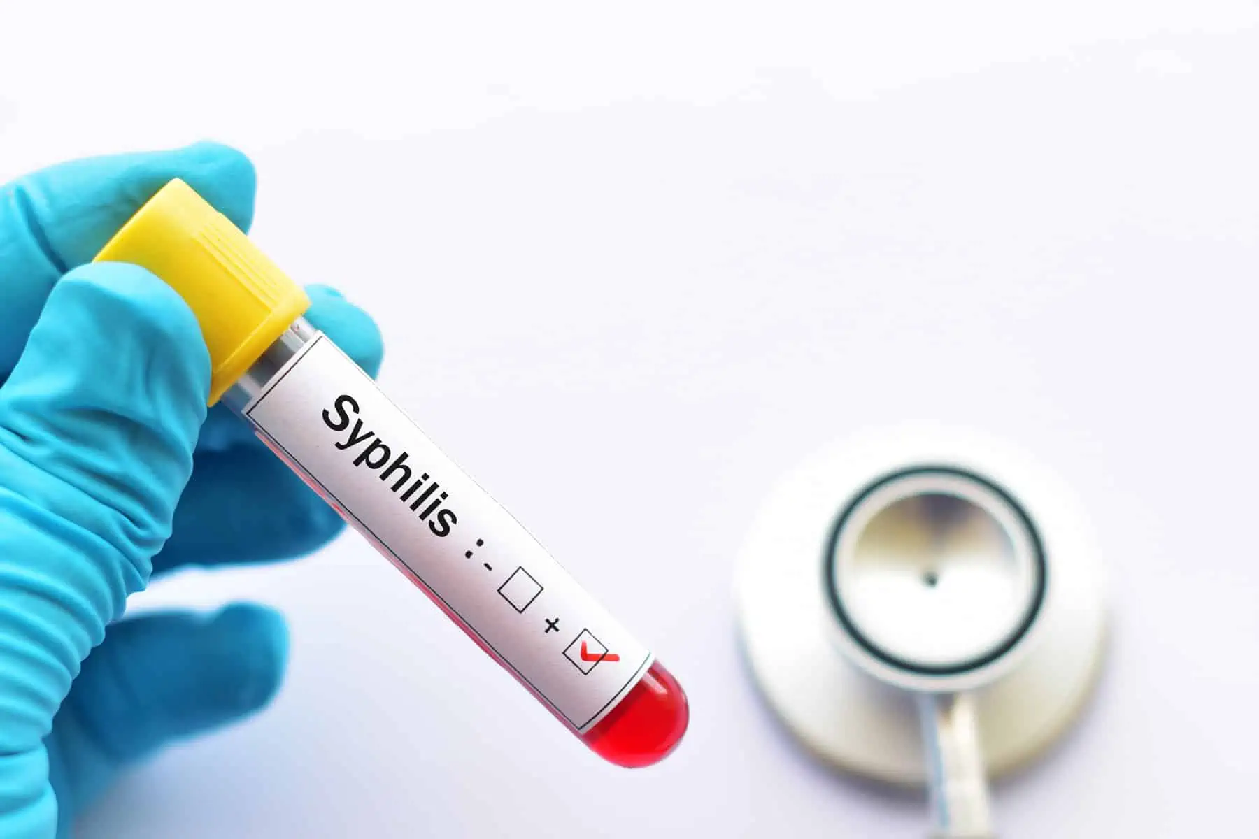 autoridades sanitarias advierten sobre brote de sifilis en houston