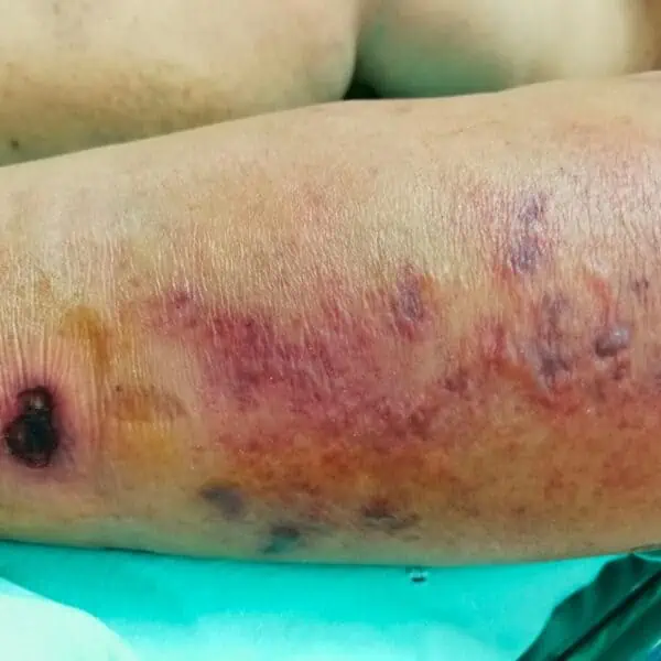 CDC Emiten Alerta de Salud Por Infecciones Graves Provocados por Bacteria Carnivora